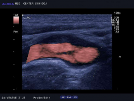 Ultrazvok vratnih žil - maščobno fibrozni plak v notranji karotidi 2